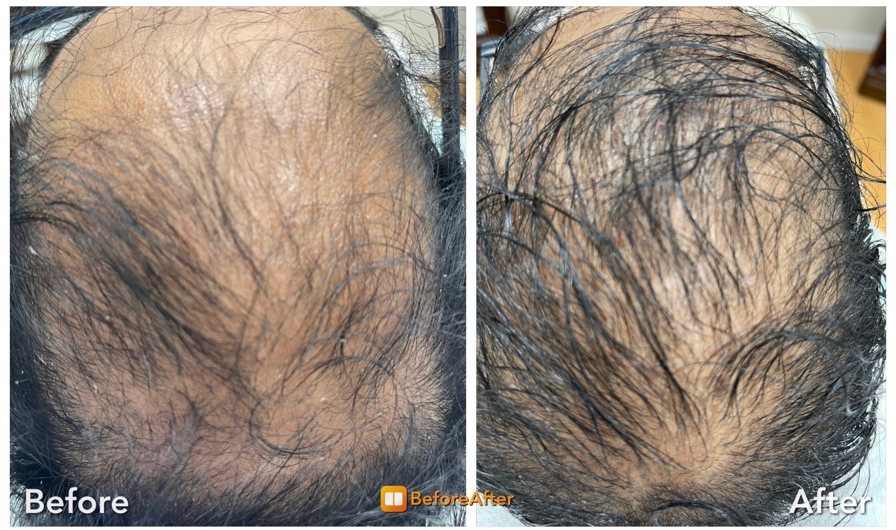 RN Laser Med Spa Hair Restoration