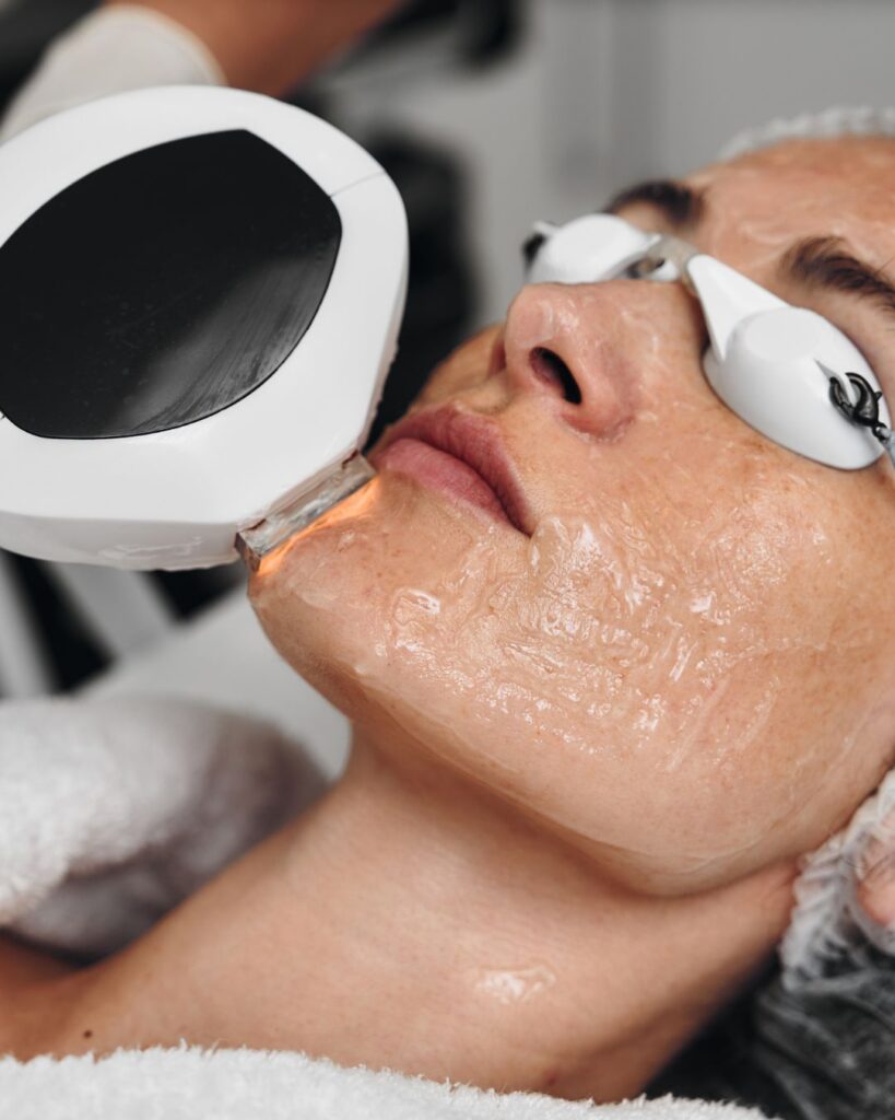 ipl laser treatment fort pierce