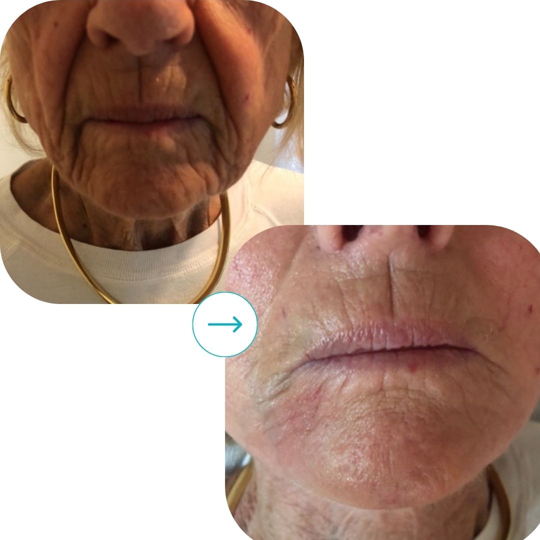 before and after med spa fort pierce12