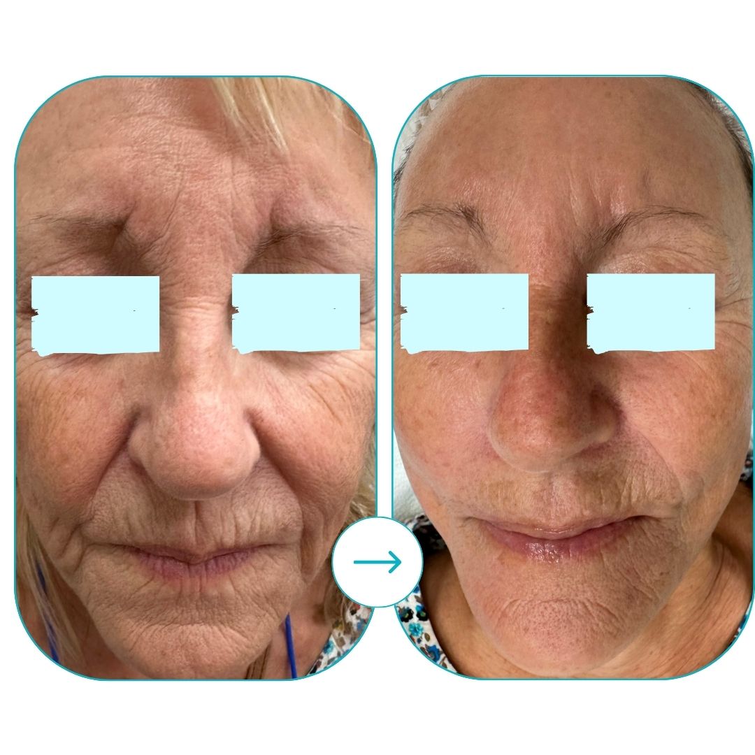 before and after med spa fort pierce13