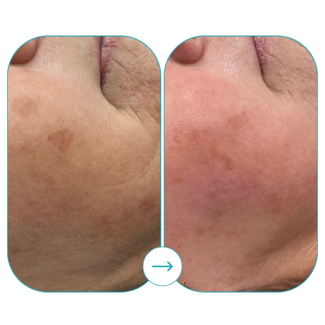 before and after med spa fort pierce14