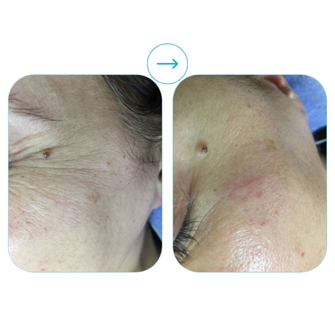 before and after med spa fort pierce4