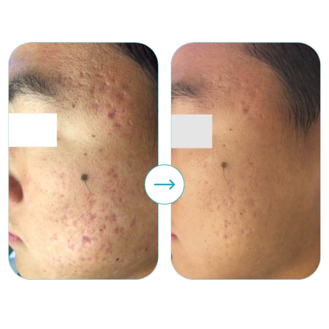 before and after med spa fort pierce6
