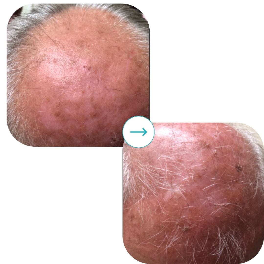 before and after med spa fort pierce7