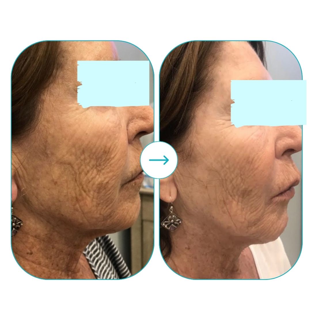 before and after med spa fort pierce9